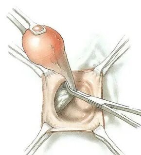Бартолиновая железа киста фото: Киста бартолиновой железы - 