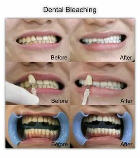 Promo Bleaching 68% + Bonus Gratis Puri Dental Clinic