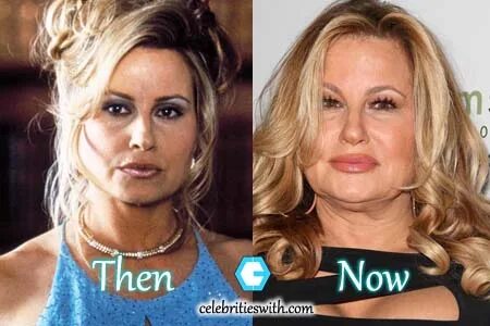 Jennifer Coolidge Plastic Surgery: Before After Facelift Pic