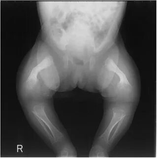 Hypophosphatasia - Basic Science - Orthobullets