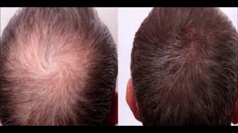 Mens Hair Loss Treatment - Virgin Coconut Oil For Hair Growt