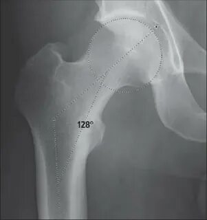 Adult Dysplasia of the Hip - Recon - Orthobullets