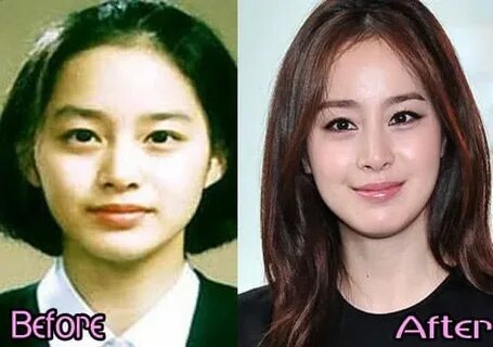 Kim Tae Hee Plastic Surgery : Plastic Surgery Examples: Kim 