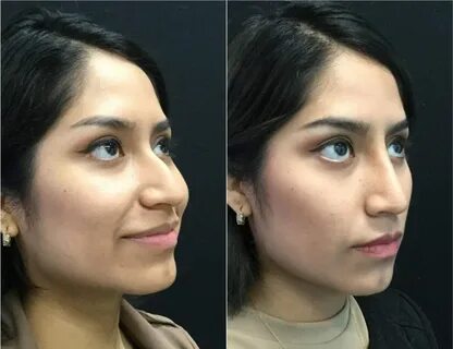 Non-Surgical Rhinoplasty Before And After Photos Fairfax