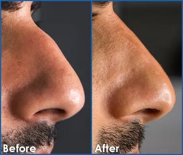 Non-Surgical Rhinoplasty Edmonton Book Your Consultation Non