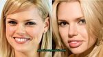Sophie Monk Plastic Surgery Before and After - Plastic Surge