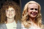 Nicole Kidman Lip Augmentation