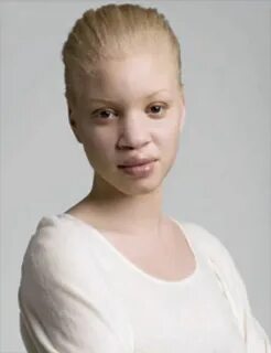 pretty albino Albinism, Black is beautiful, Albino