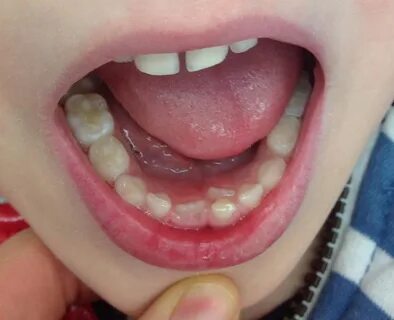 The Adult Tooth is Growing in Behind the Baby Tooth, What Sh