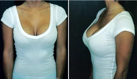 7 Advantages of High Profile Breast Implants Dr. Stuart A. L