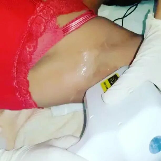 Laserbehandlung Milea в Instagram