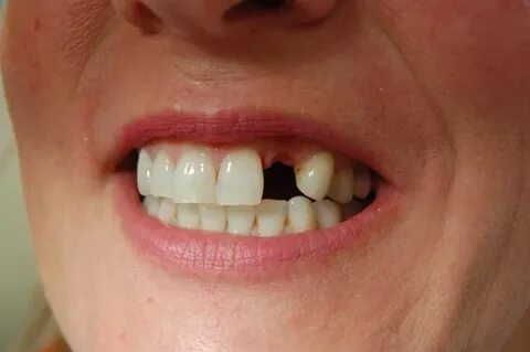 Replacing Missing Teeth With An Adhesive Bridge - Riverside 