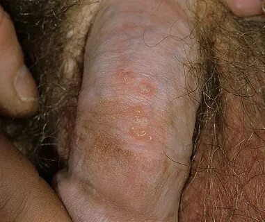 Genital Herpes Symptoms Pictures - 42 Photos & Images / illn
