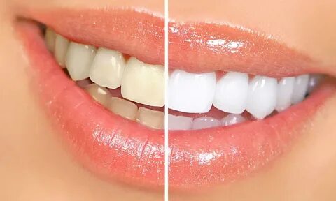 Преимущества отбеливания зубов - НealthНacks
