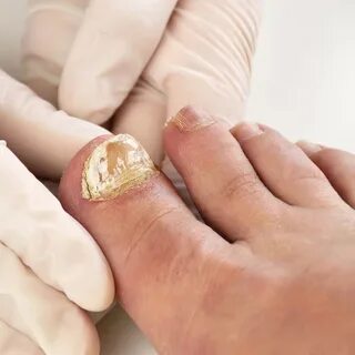 Can Toenail Fungus Spread Through Nail Polish Foot Doctor Ma