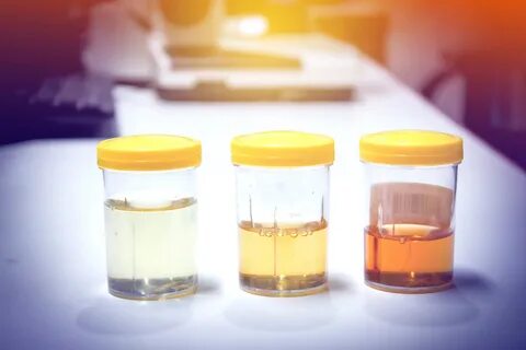 What Does Your Urine Say About Your Bladder Health?