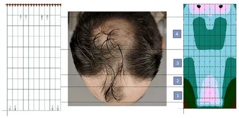 The Scalp Tension Theory Of Hair Loss: A Scientific Breakdow