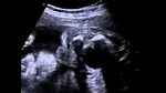 Real-time ultrasound of fetal diphallia: Video 2 - YouTube