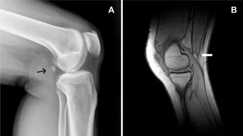 A) X-ray of popliteal cyamella in knee OA, shown by black ar