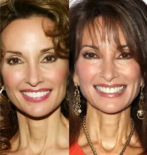 Susan Lucci Plastic Surgery