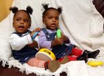 Siamese twins separated in infancy continue to sleep the sam