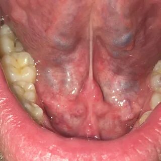 Bubble under my tongue Ranula: Causes, Symptoms, Diagnosis a