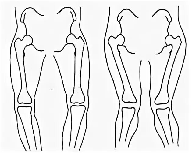 Knock knees Knee Injury Care Aurangabad Bow Legs Correction 