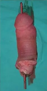 Scrolldrop penectomy