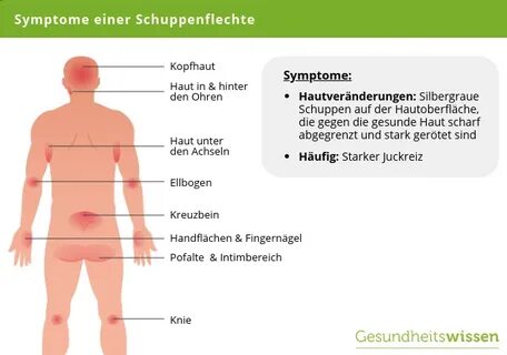 Schuppenflechte - Symptome, Ursachen & Behandlung