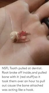 NSFL Tooth Pulled at Dentist Root Broke Off Insideand Pulled