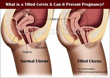 Inverted uterus porn.