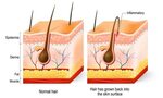 Ingrown Beard Hairs: Prevention & Proven Remedies (Guide)