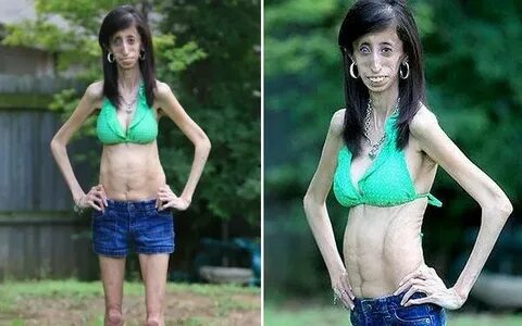 Skinniest Person in the World - Lizzie Velasquez Skinny, Bik