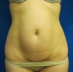Mini Tummy Tuck C Section Scar Revision