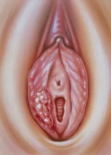 Illustration Of Carcinoma Of The External Vagina Photograph 