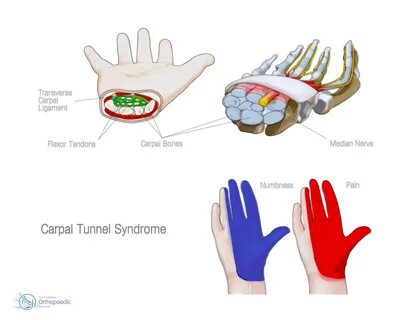 Carpal Tunnel Syndrome Orthopaedic - Ian Whitaker