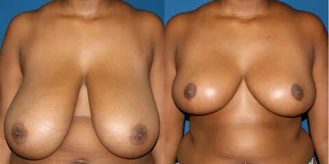 Before and After Breast Reduction.