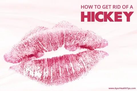 How to Get Rid of a Hickey Quickly: 27 Proven and Effective 