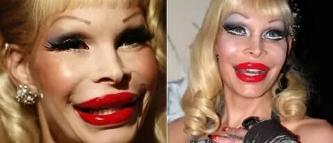 Cosmetic Surgery Fail Gossip Ghirl Пластическая хирургия, Фа