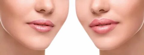 Контурная пластика губ: особенности процедуры