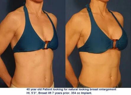 Bednar Cosmetic Surgery of Charlotte Offers Fat Cell Transfe