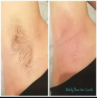 Before and after underarm wax #dayton #ohio #brazilianwaxing