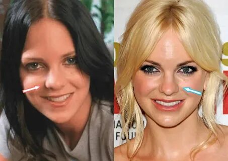 Anna Faris Plastic Surgery REVEALED (Before & After 2021)