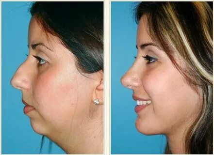 Rhinoplasty nose jobs, Rhinoplasty, Nose surgery