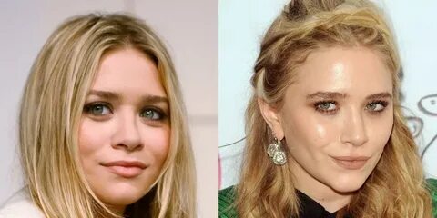 Mary-Kate Olsen before and after plastic surgery 05 Celebrit