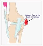 Popliteal Cyst (or Baker’s Cyst) Natural Relief OSMO Patch U