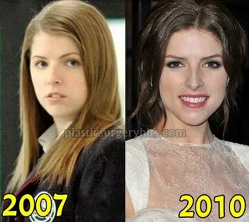 Anna Kendrick Plastic Surgery Fact or Just a Pure Rumor? - P