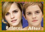Emma Watson Plastic Surgery Nose Job Rhinoplasty Surgeons Ru