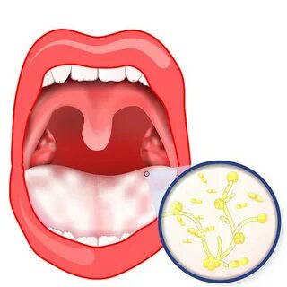 8 وصفات منزلية لعلاج فطريات الفم - بالأعشاب وبدون أدوية -ط--