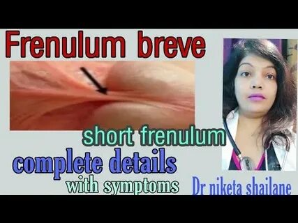 What is Frenulum breve short frenulum complete details with 